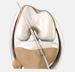 ACL Reconstruction