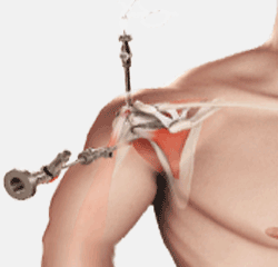 Arthroscopic Rotator Cuff Repair