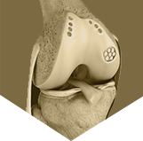 Cartilage Restoration