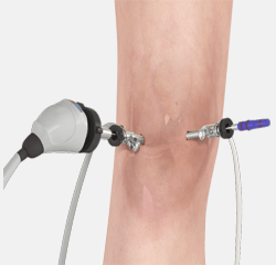 Knee Arthroscopy