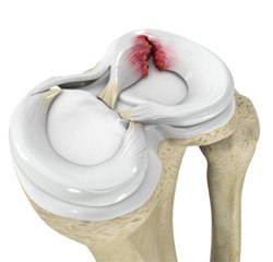 Meniscus Tear