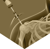 Arthroscopic Shoulder  Stabilization