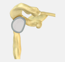 Arthroscopic Shoulder Stabilization | Shoulder Treatment Naperville, IL